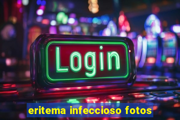 eritema infeccioso fotos